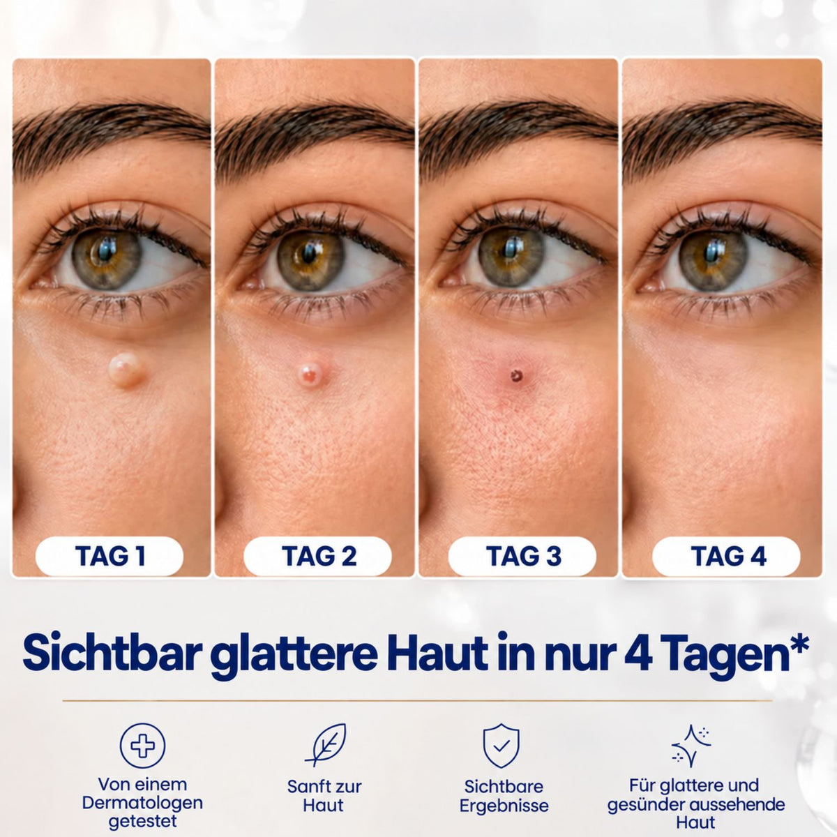 AcroSoft™ | Glatte Haut in nur 4 Tagen