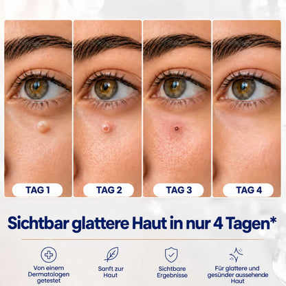 AcroSoft™ | Glatte Haut in nur 4 Tagen
