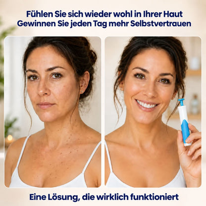 AcroSoft™ | Glatte Haut in nur 4 Tagen